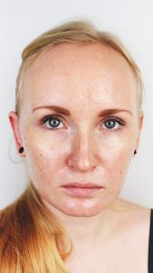 penyebab wajah berminyak